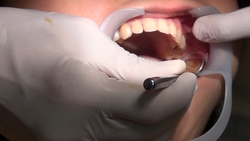Dental treatment video Minami ISHIKAWA fixes three cavities at once