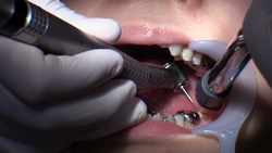 Dental Treatment ; Amateur Girl AOI (1st Time: Extreme Close Up of MOUTH)