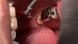 业余葵的真实牙科治疗视频（第二次：口腔特写）*这是同名作品，仅包含口腔内部特写！