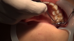 Dental Treatment ; Mikoto MISAKA (1st Time: Extreme Close Up of MOUTH)